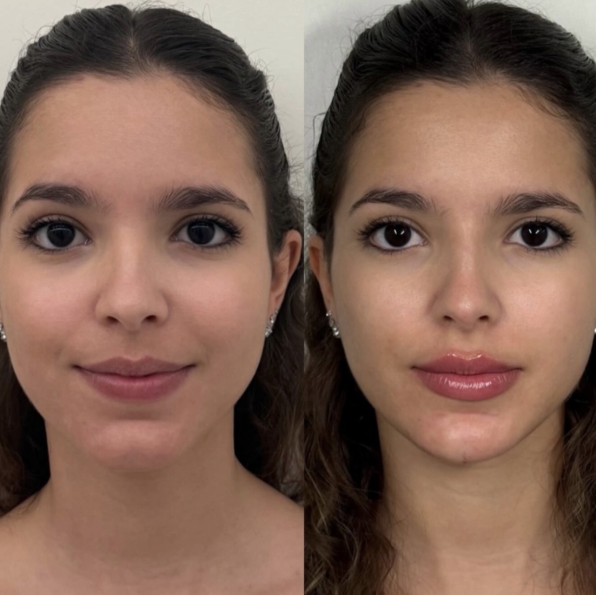 Harmonização facial frontal — antes e depois
