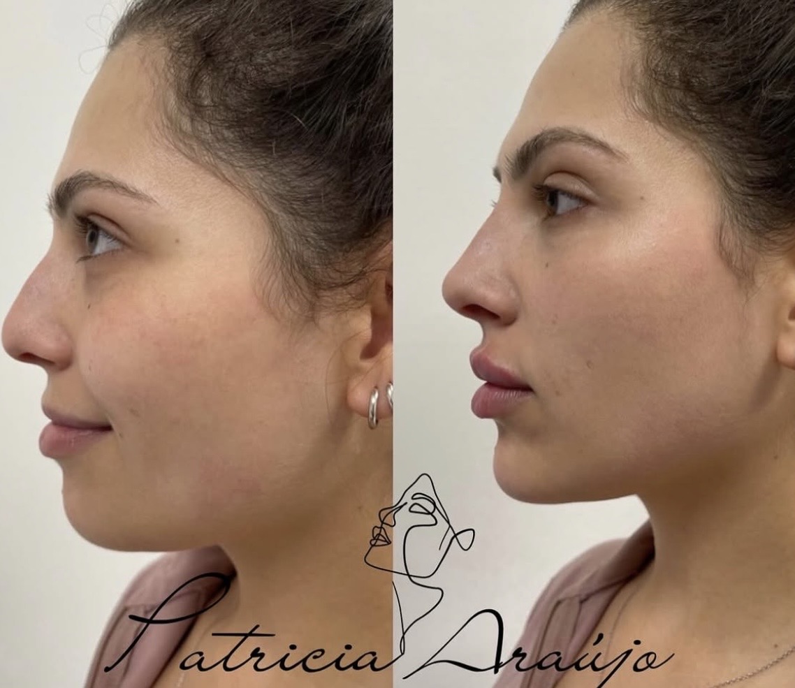 Harmonização facial de perfil — antes e depois