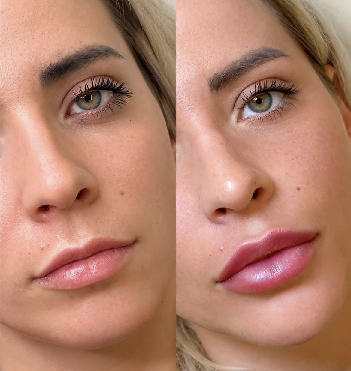 Preenchimento labial — antes e depois
