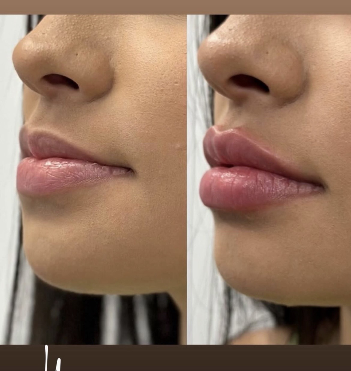 Preenchimento labial — antes e depois