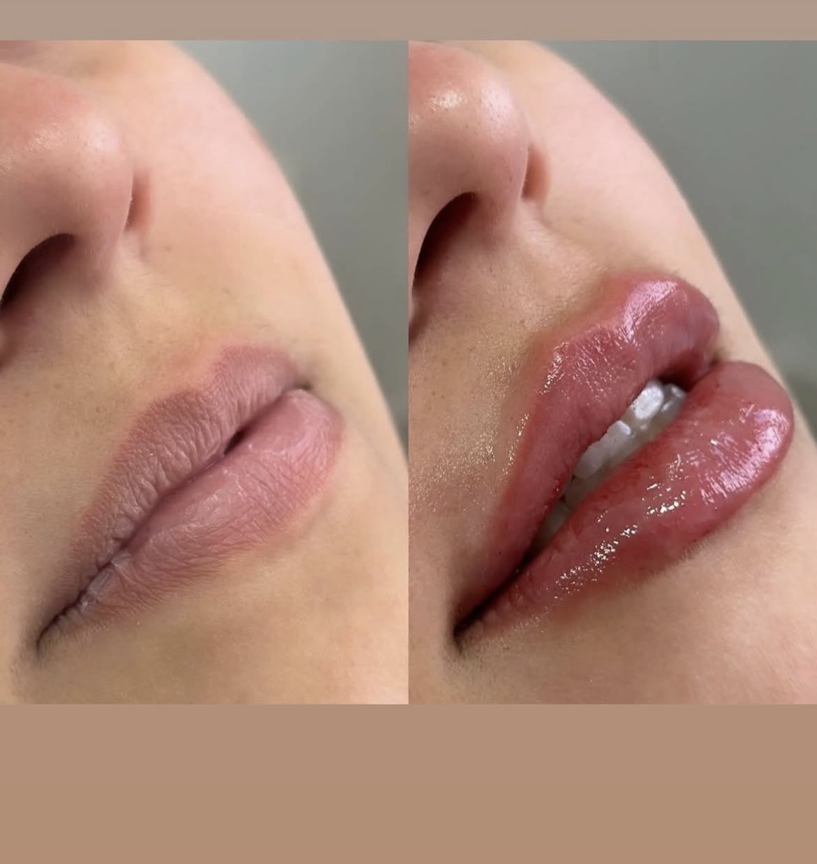 Preenchimento labial — antes e depois