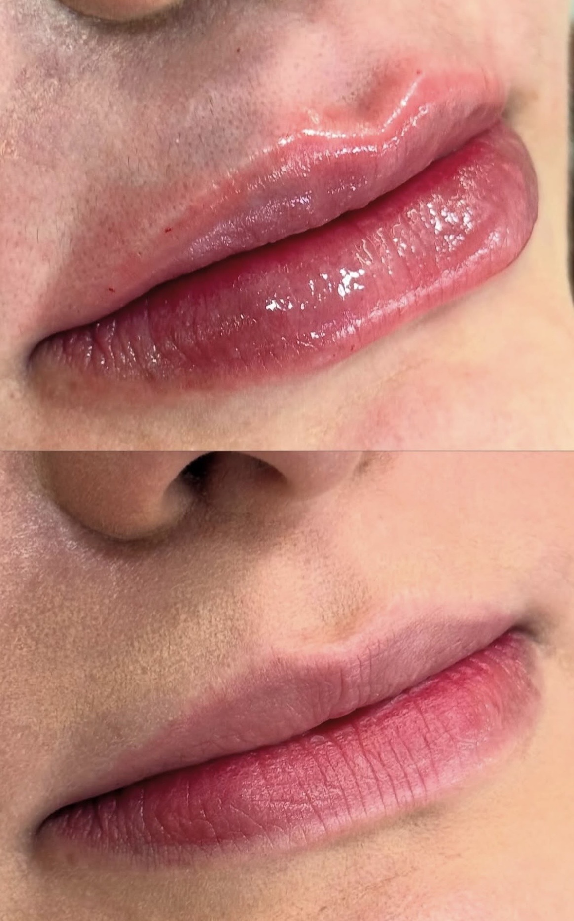 Preenchimento labial em detalhe — antes e depois