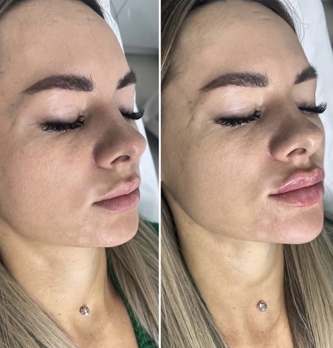 Preenchimento labial de perfil — antes e depois