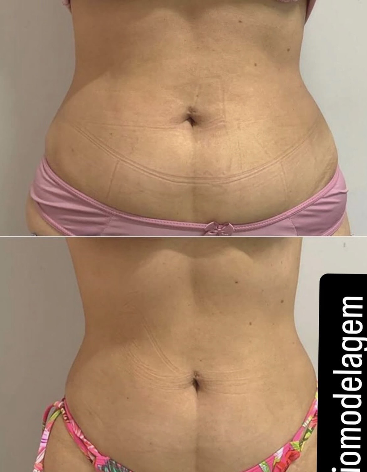 Lipomodelagem de abdômen — antes e depois