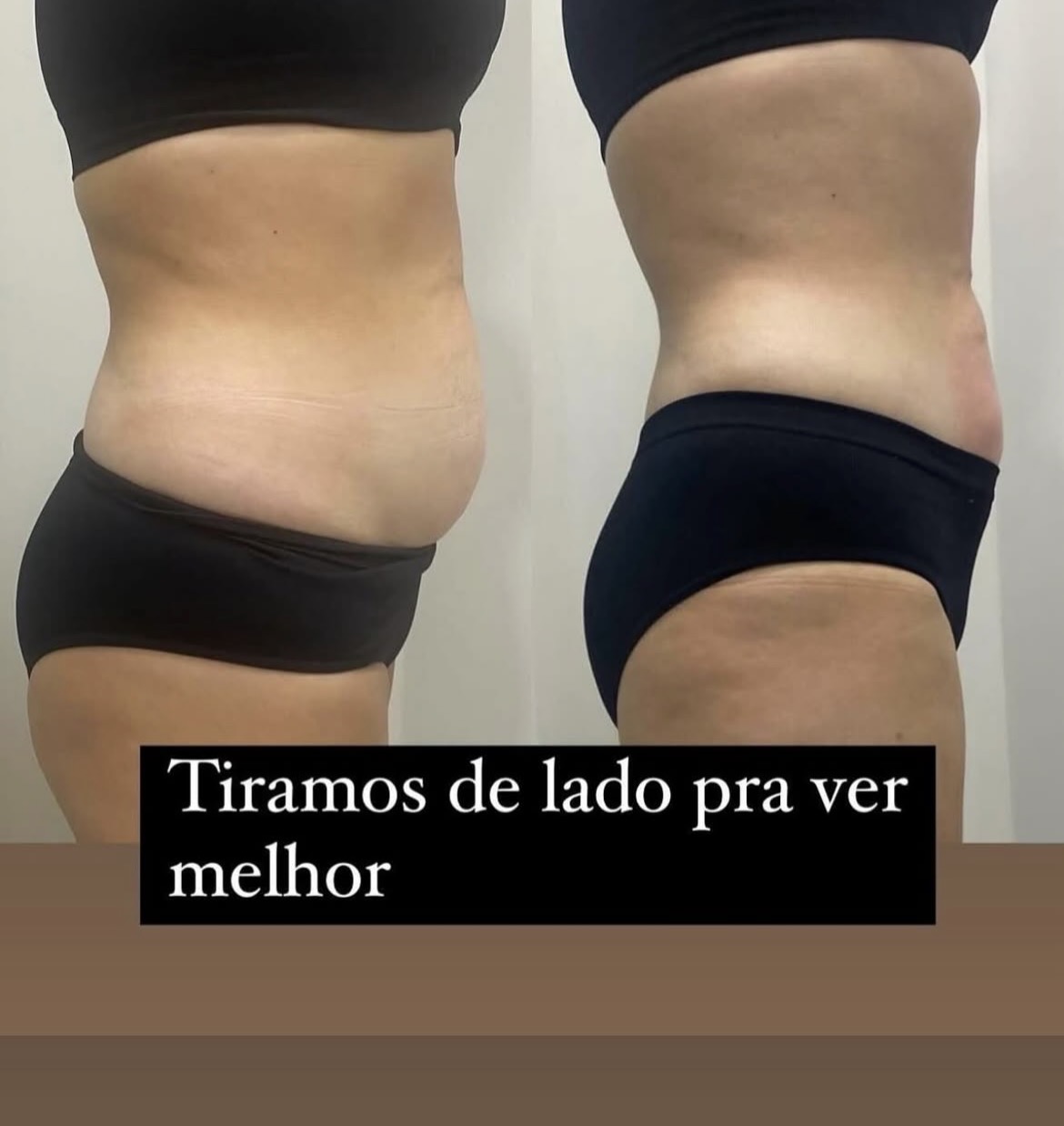 Lipomodelagem de abdômen de perfil — antes e depois