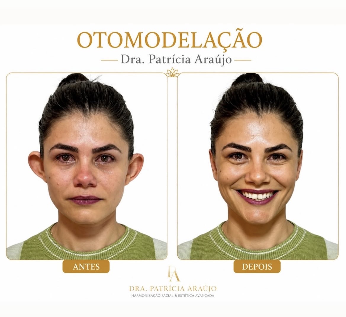 Otomodelação — antes e depois