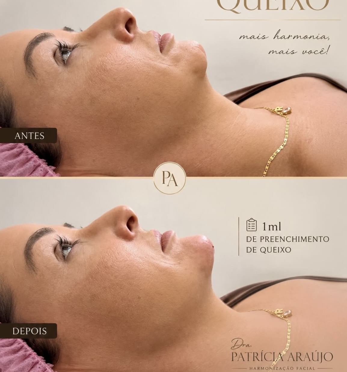 Preenchimento de queixo com 1ml — antes e depois