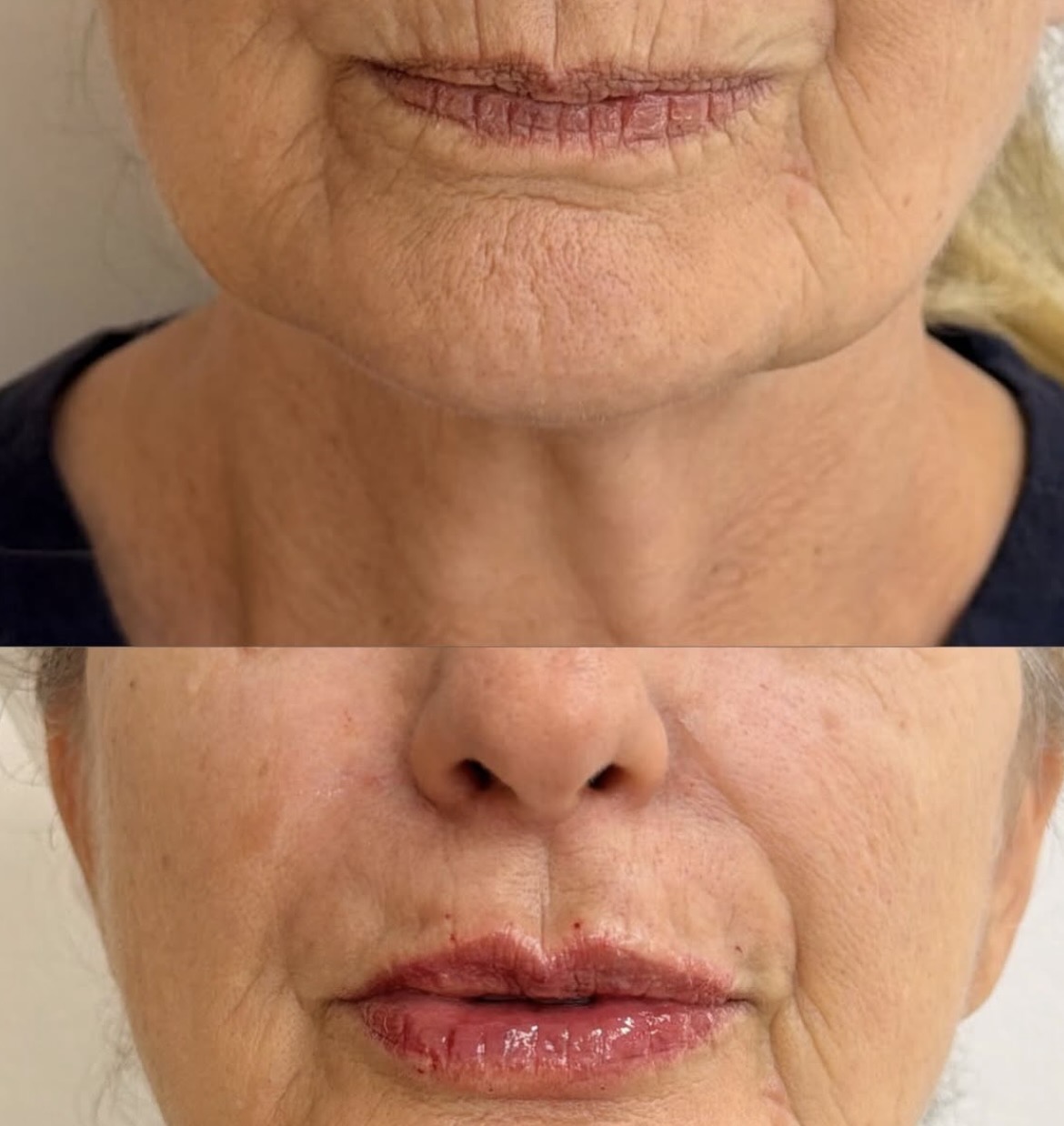 Rejuvenescimento labial — antes e depois