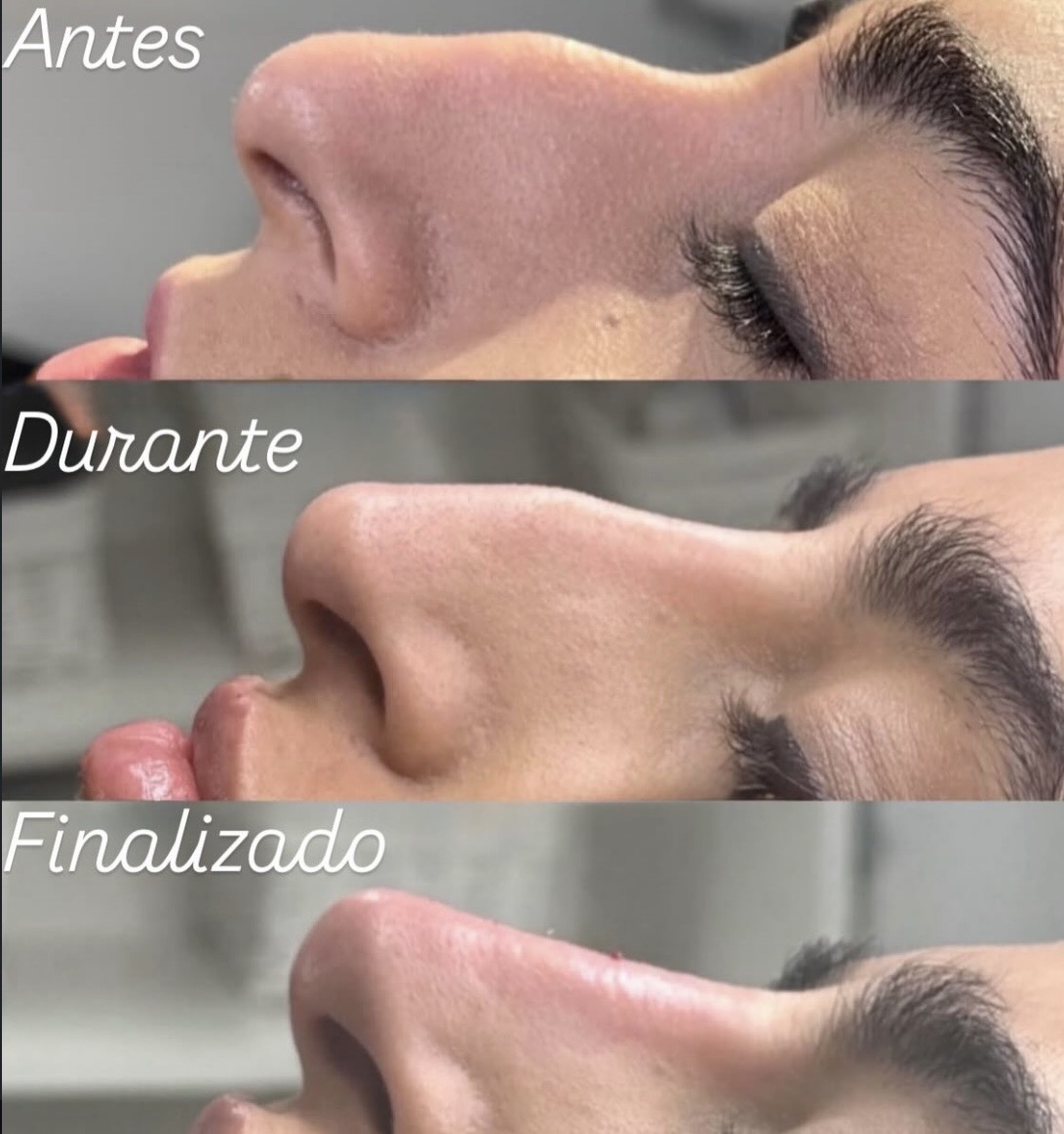 Rinomodelação — antes, durante e finalizado