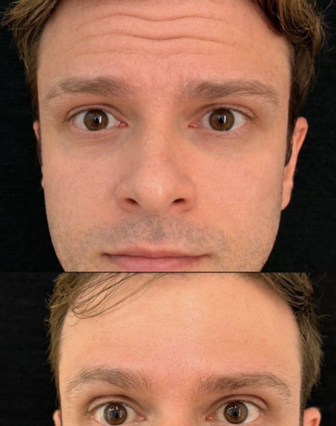 Toxina botulínica na testa — antes e depois